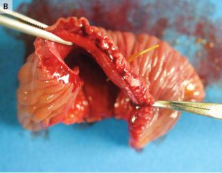 魚の骨　小腸　貫通　手術